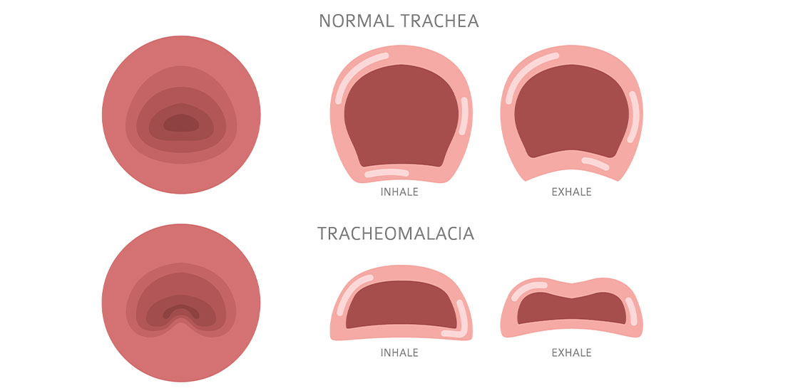 Normal and abnormal views (tracheomalacia) of a trachea