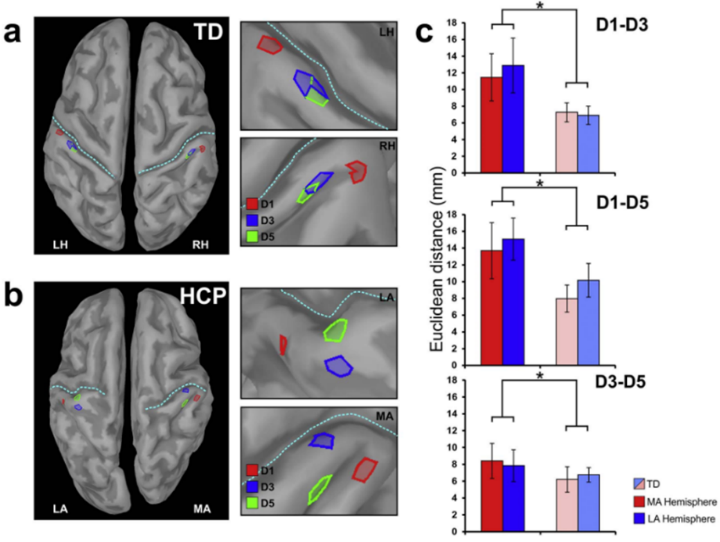 MEG-fig1-MovementDis