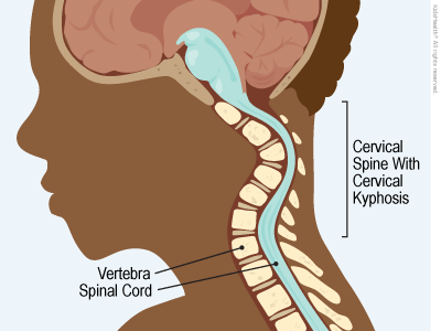 cervicalKyphosis_400x300_enIL