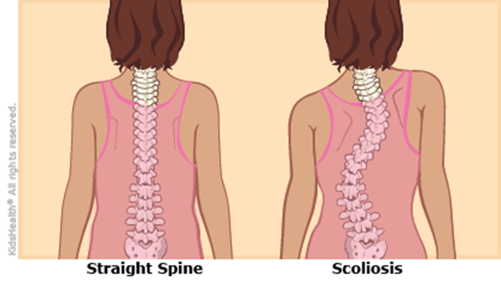 scoliosiscroppeda-415x233-enil-main