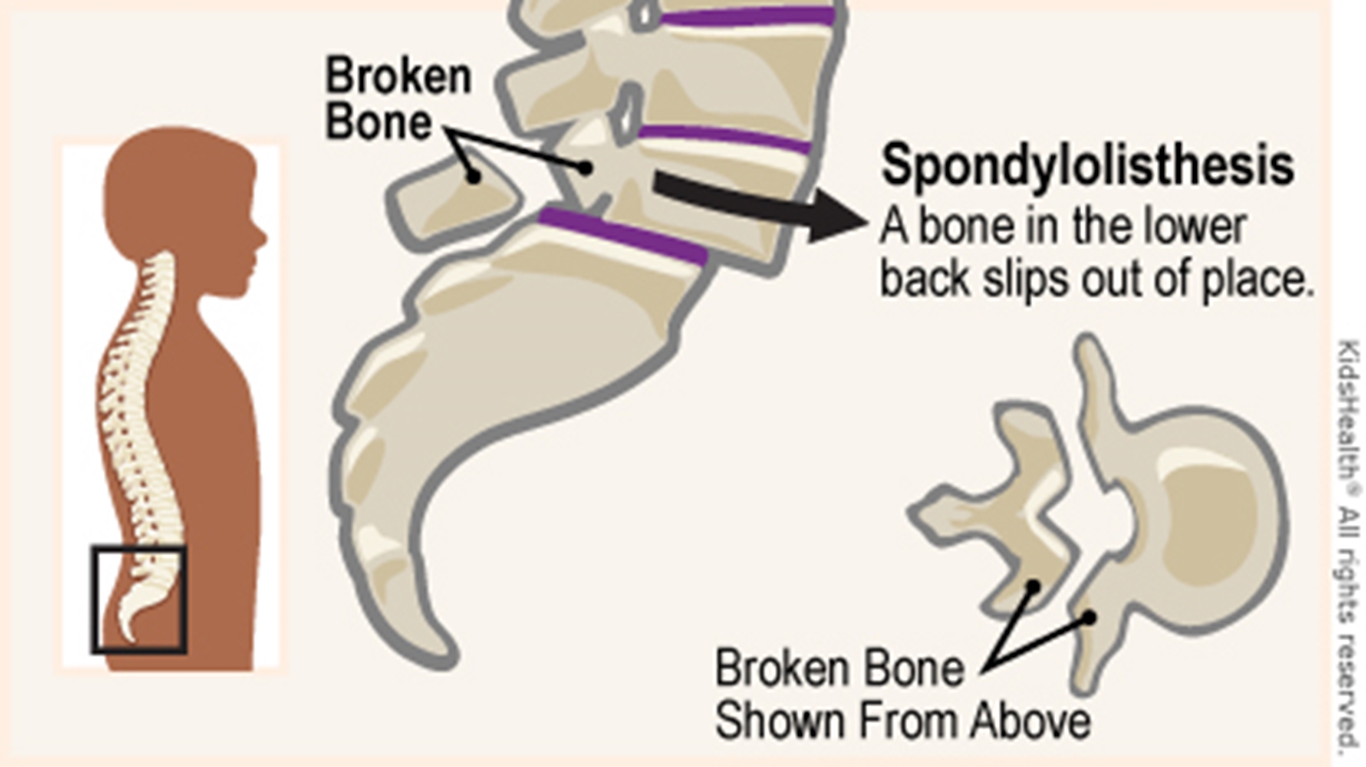 spondylolisthesis_a_enil-main
