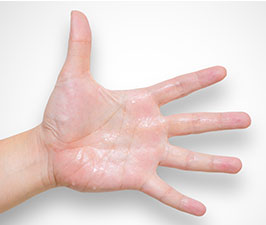 hyperhidrosis